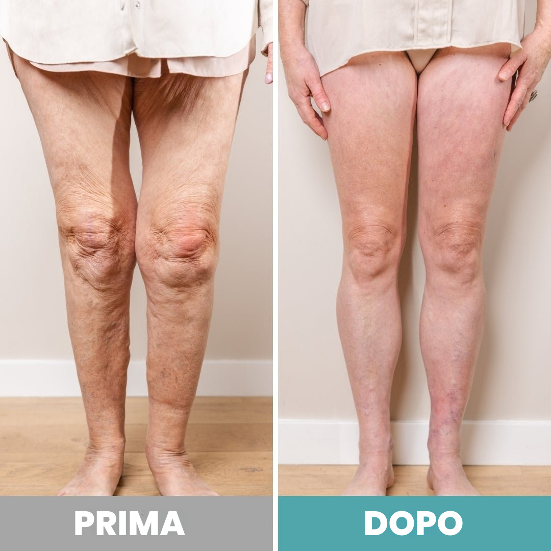 RinovaX™ – Elektrisk fotmassageapparat